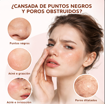 Removedor de Puntos Negros Por Succion